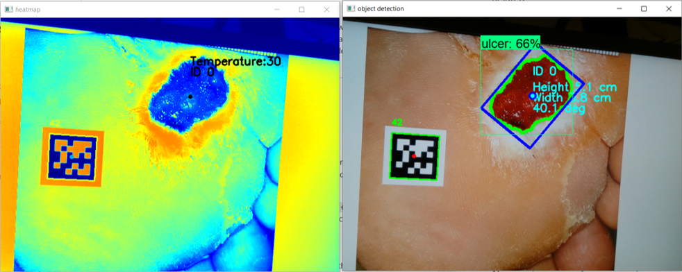 DiaVision ulcer detection